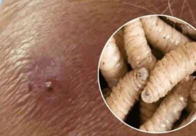 Veracruz concentra la mayor presencia territorial de miasis humana por gusano barrenador